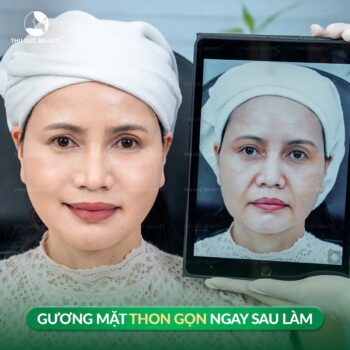 Nâng cơ bằng công nghệ Ultherapy có hiệu quả không?