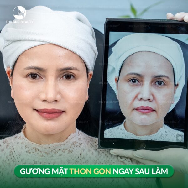 Nâng cơ bằng công nghệ Ultherapy mang lại hiệu quả cao.