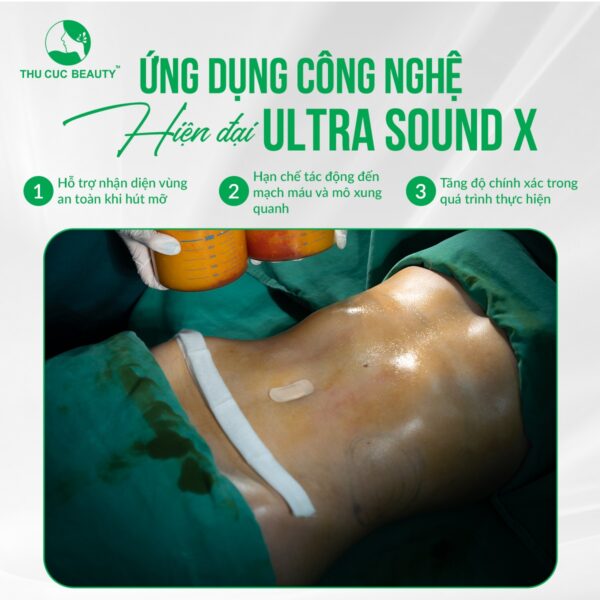Hút mỡ công nghệ Ultra Sound X
