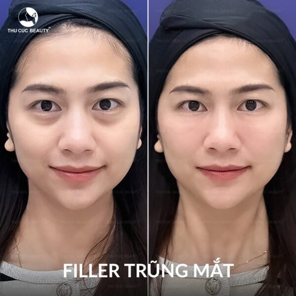 1CC filler giúp làm đầy trũng mắt sâu