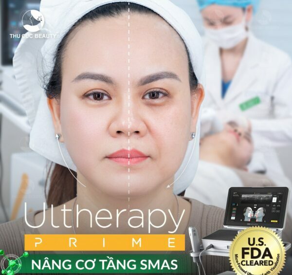 Nâng cơ hiệu quả bằng Ultherapy