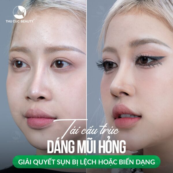 Nâng mũi dáng L-Line
