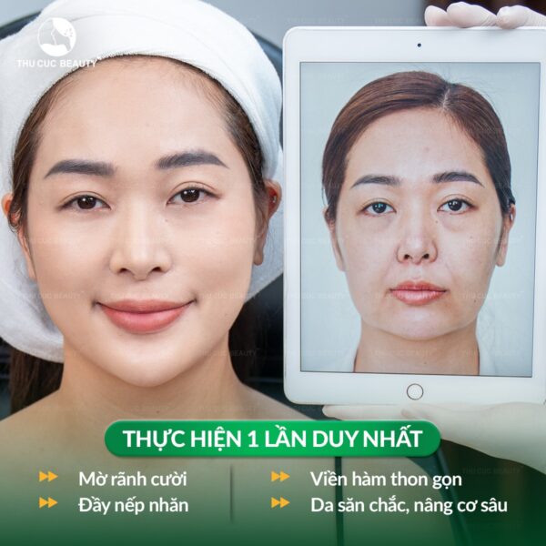 Làm đẹp bằng công nghệ Ultherapy