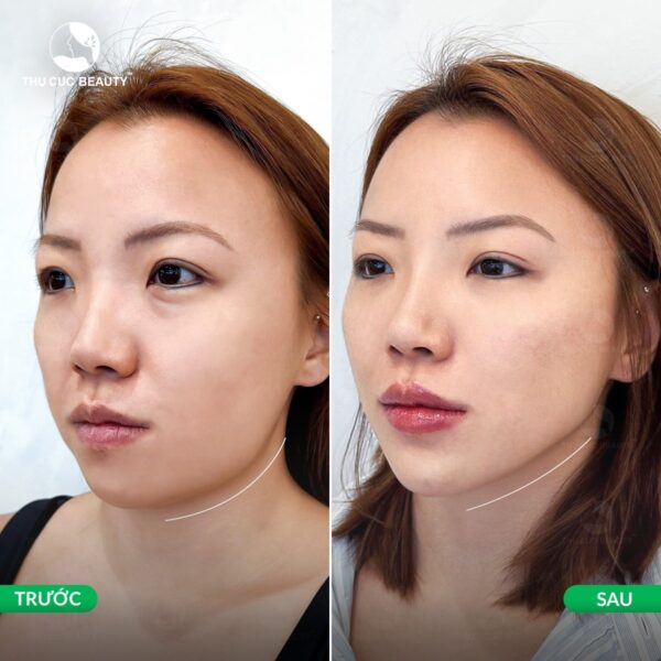 Các biểu hiện sau khi tiêm Botox gọn hàm cần biết 2 tiem botox gon ham e1778841261630