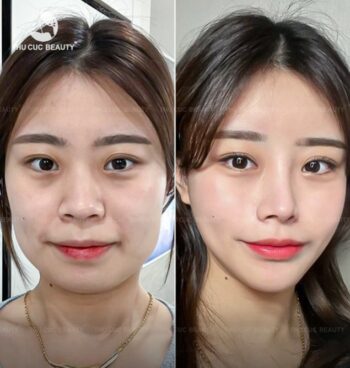 Cập nhật giá tiêm botox gọn hàm trên thị trường hiện nay