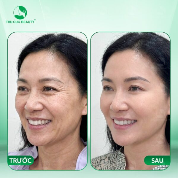 tiem botox o dau uy tin e1778496957484