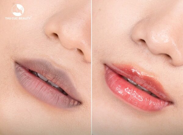Trị môi thâm có được vĩnh viễn không?