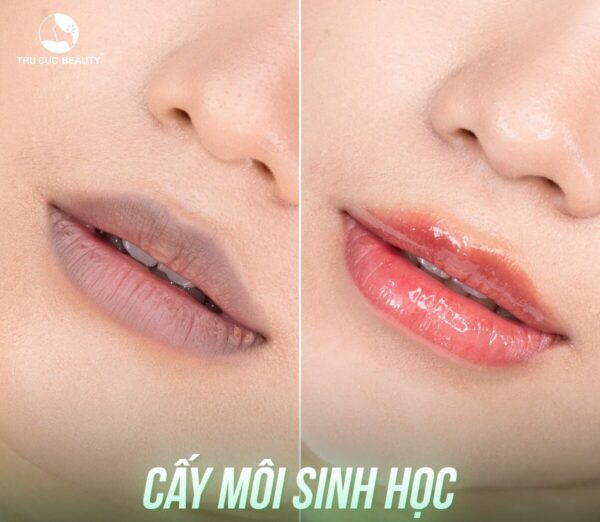 Cấy môi sinh học giúp cải thiện môi thâm sạm trở nên hồng hào, tươi đẹp.