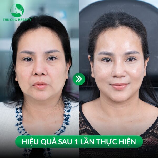 Nâng cơ bằng công nghệ Ultherapy mang lại hiệu quả cao.
