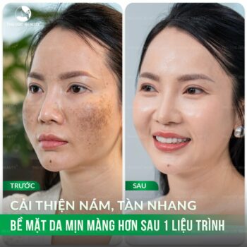 Bắn laser trị nám bao lâu thì hết?