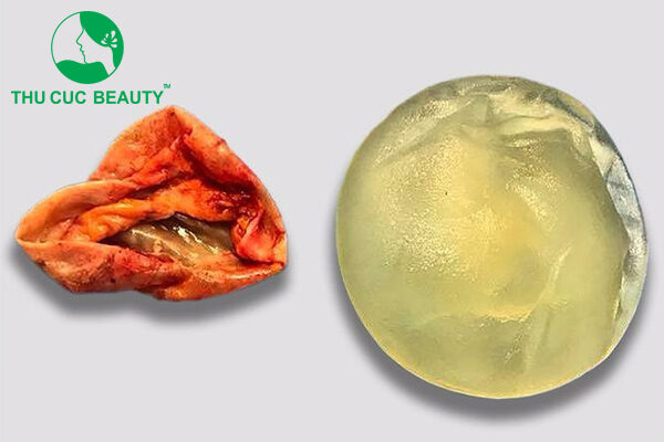 Bao xơ ngực có nguy hiểm không? 1 Dấu hiệu bao xơ ngực
