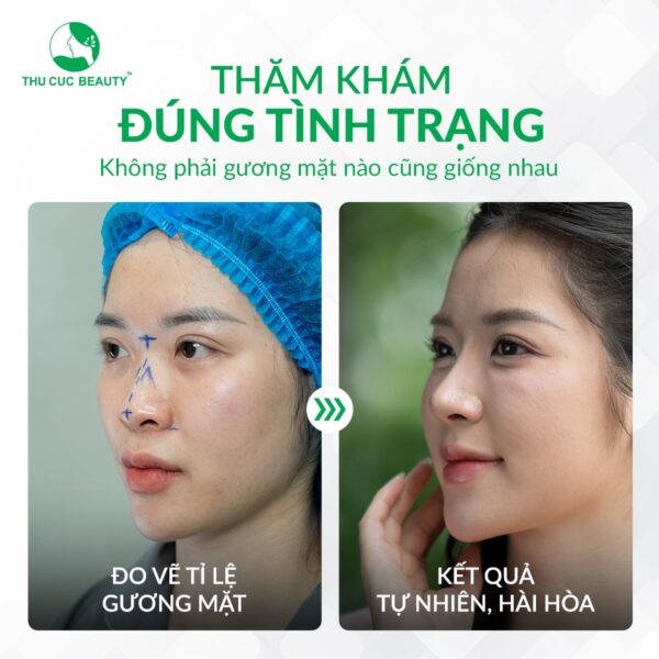 Quy trình nâng mũi chuẩn y khoa diễn ra như thế nào? 3 hieu qua nang mui e1780480408842