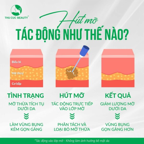 Công nghệ hút mỡ bằng sóng siêu âm giúp hạn chế tối đa xâm lấn