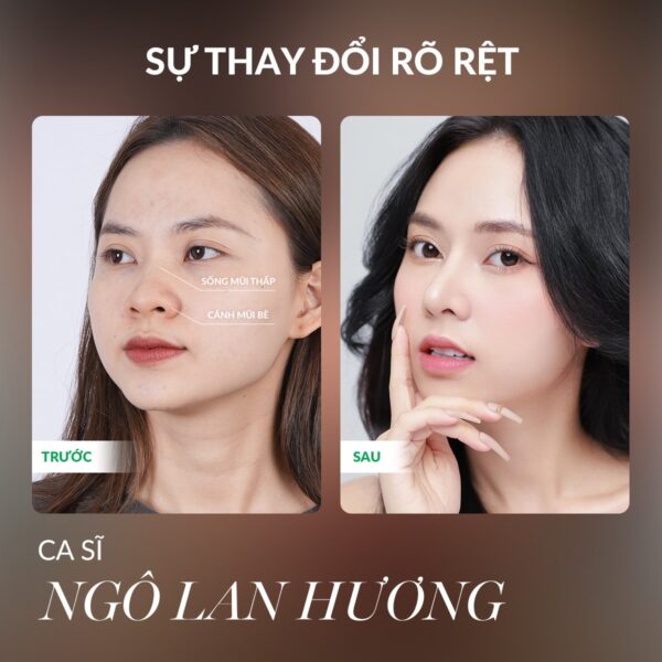 Quy trình nâng mũi chuẩn y khoa diễn ra như thế nào? 6 Bệnh viện Thẩm mỹ Thu Cúc thực là lựa chọn tin cậy của nhiều nghệ sĩ, người nổi tiếng.