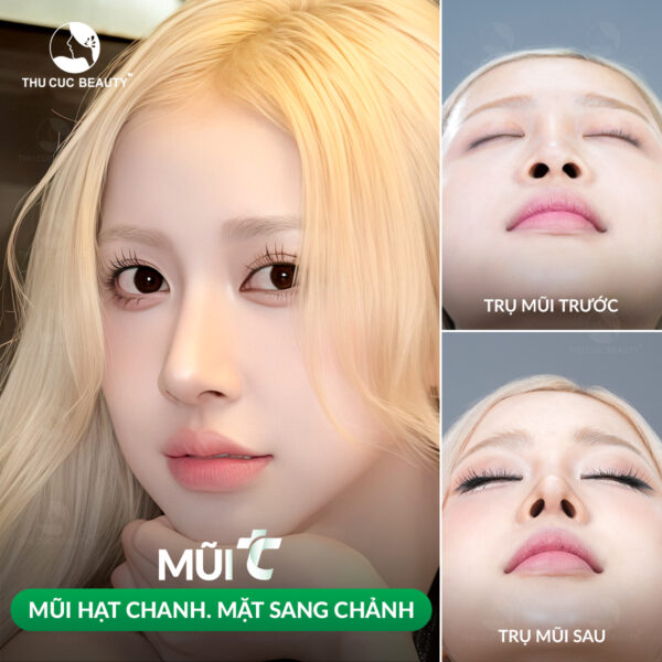Quy trình nâng mũi chuẩn y khoa diễn ra như thế nào? 7 nang mui dep e1780479667108