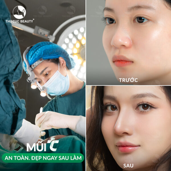 Quy trình nâng mũi chuẩn y khoa diễn ra như thế nào? 4 Nâng mũi cần được thực hiện bởi bác sĩ chuyên khoa.