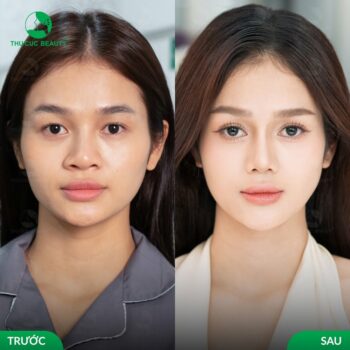 Phẫu thuật thu nhỏ đầu mũi và những lưu ý quan trọng