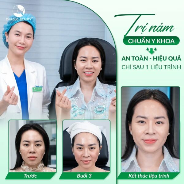 Bắn laser trị nám bao lâu thì hết? 3 Trị nám chuẩn y khoa, an toàn, hiệu quả.