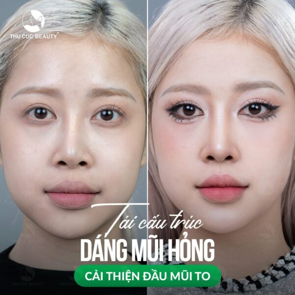 Phẫu thuật thu nhỏ đầu mũi