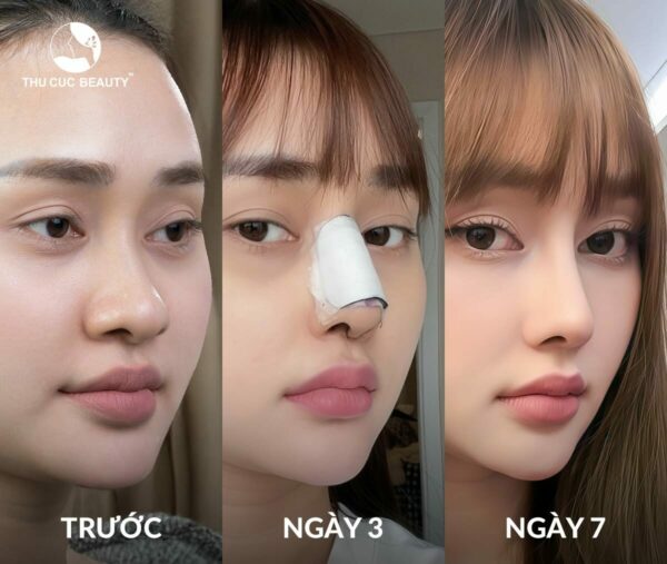 Phẫu thuật thu nhỏ đầu mũi kết hợp nâng sống mũi.