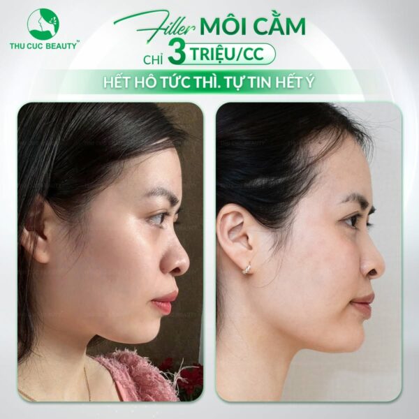 Tiêm filler cằm bao lâu thì ổn định?