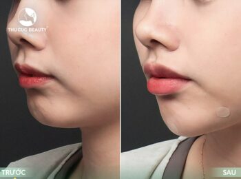 Tiêm filler cằm bao lâu thì ổn định?