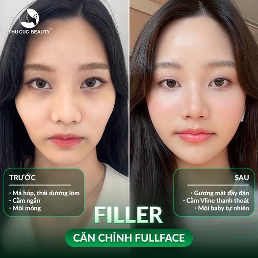 Ưu nhược điểm của cấy mỡ tự thân là gì? Có nên cấy mỡ không? 5 Tiêm Filler cho hiệu quả nhanh, quy trình đơn giản nhưng sẽ tan hết dần theo thời gian.