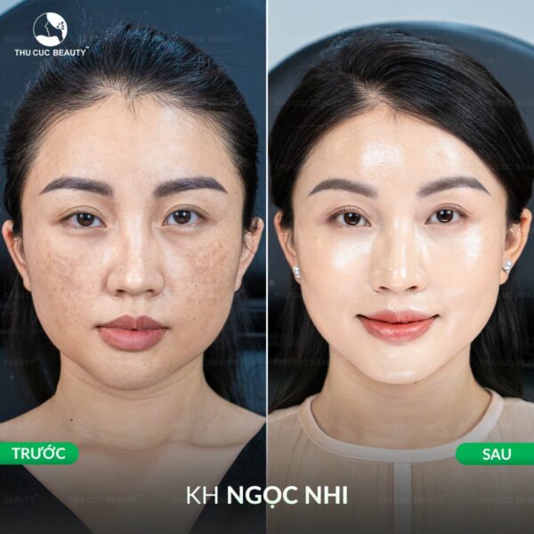 Sau khi tiêm meso bao lâu thì đẹp?