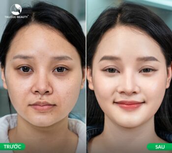 Sau khi tiêm meso bao lâu thì đẹp?