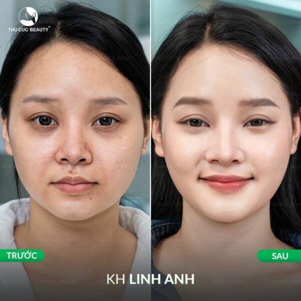 Hiệu quả tiêm meso tại BVTM Thu Cúc
