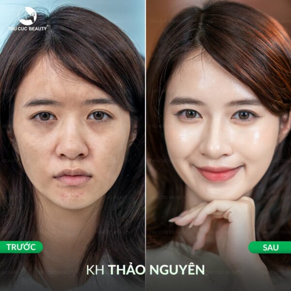 Tiêm meso giúp cải thiện da sáng lên.