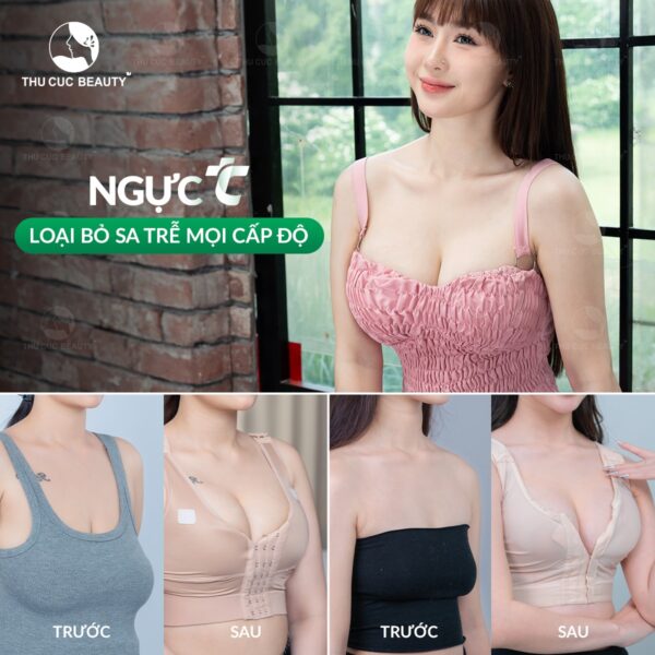 Treo ngực sa trễ nên đặt túi độn để đạt tính thẩm mỹ tối ưu.