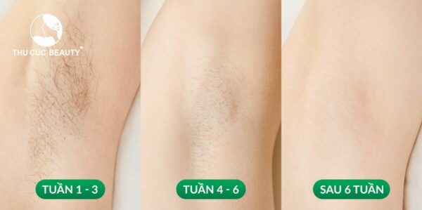 Triệt lông có hết vĩnh viễn không? 2 Triệt lông bằng laser không gây đau rát, ngăn lông mọc trở lại