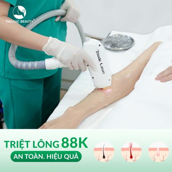 Triệt lông có hết vĩnh viễn không? 4 Triệt lông tại Thu Cúc với ưu đãi hấp dẫn